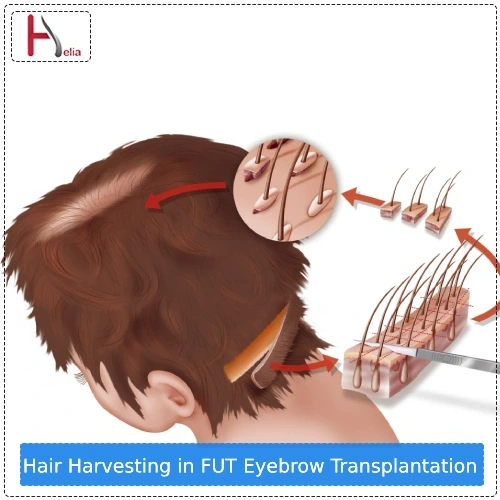 Hair Harvesting in FUT Eyebrow Transplantation