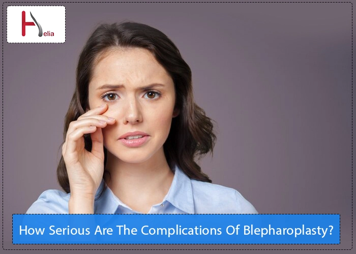 How Serious Are The Complications Of Blepharoplasty?