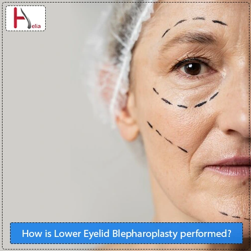 How is Lower Eyelid Blepharoplasty performed?