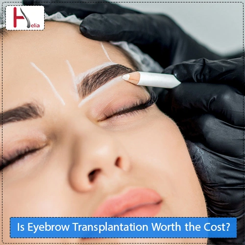 Is Eyebrow Transplantation Worth the Cost?