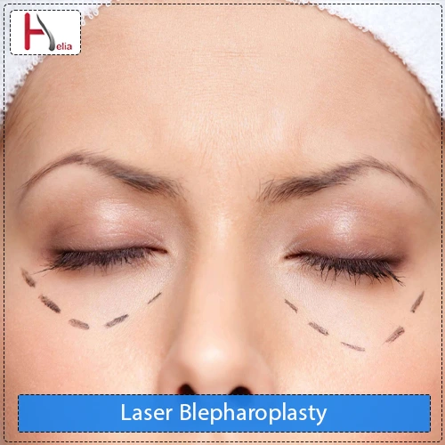 Laser Blepharoplasty