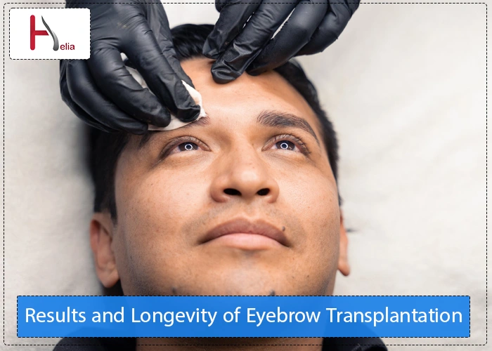 Results and Longevity of Eyebrow Transplantation