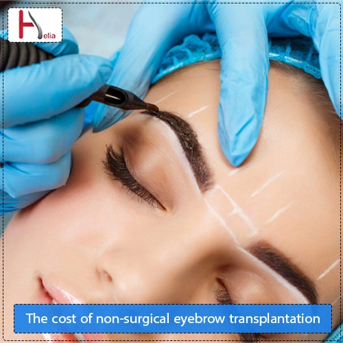 The cost of non-surgical eyebrow transplantation