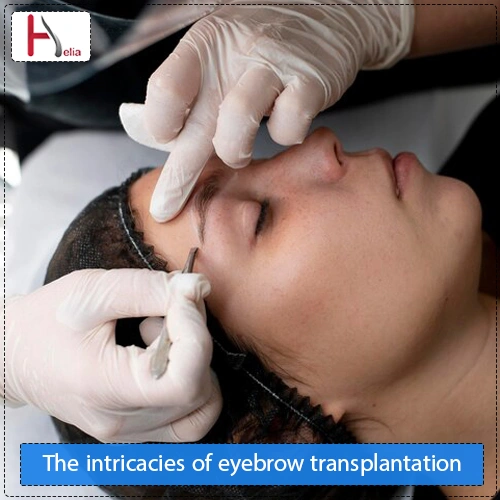 The intricacies of eyebrow transplantation