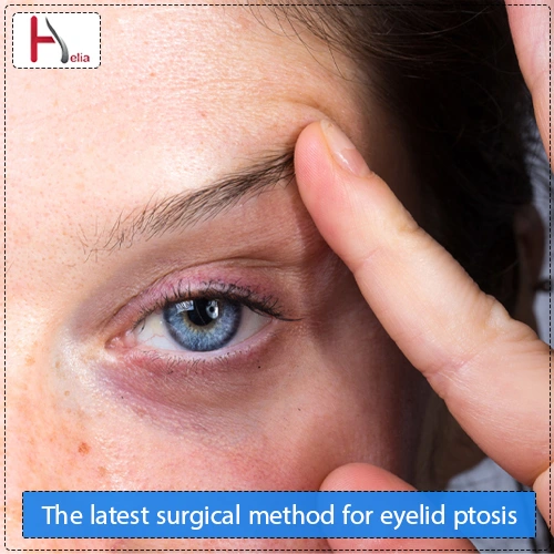 The latest surgical method for eyelid ptosis