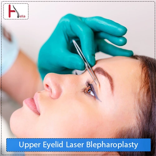 Upper Eyelid Laser Blepharoplasty