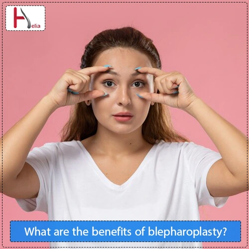 What are the benefits of blepharoplasty?
