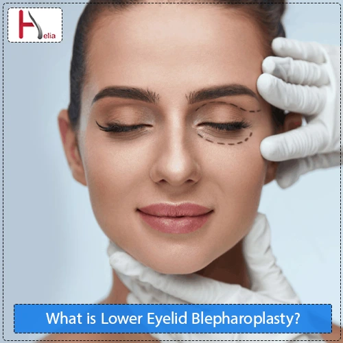 What is Lower Eyelid Blepharoplasty?