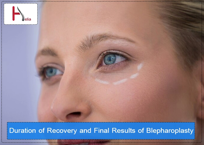 Duration of Recovery and Final Results of Blepharoplasty