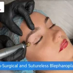 Non-Surgical and Sutureless Blepharoplasty
