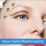 Upper Eyelid Blepharoplasty