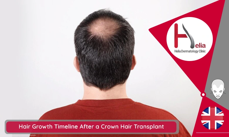 Hair Growth Timeline After a Crown Hair Transplant