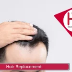 Hair Replacement