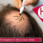 Hair Transplant in the Crown Area