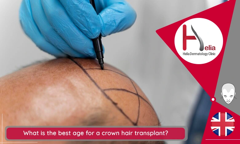 What is the best age for a crown hair transplant?