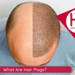 Comparison of Hair Transplantation with Hair Plugs