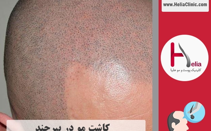 کاشت موی طبیعی در شهر بیرجند