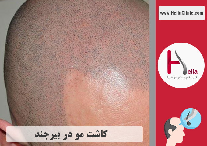 کاشت موی طبیعی در شهر بیرجند