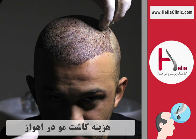 هزینه کاشت موی طبیعی در شهر اهواز