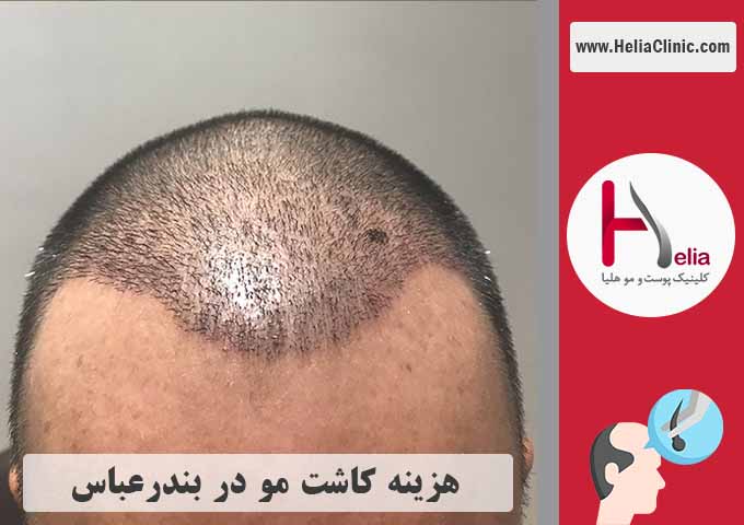 قیمت و تعرفه تقریبی کاشت مو در بندرعباس