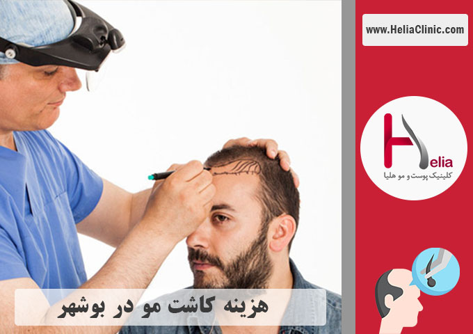 قیمت کاشت موی طبیعی در شهر بوشهر