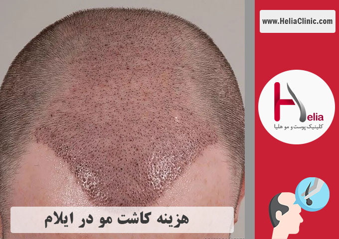 قیمت کاشت موی طبیعی در شهر ایلام