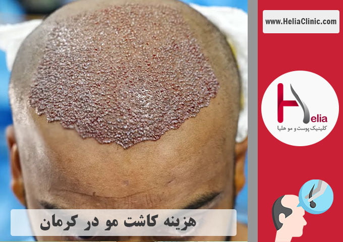 قیمت کاشت طبیعی مو در کرمان