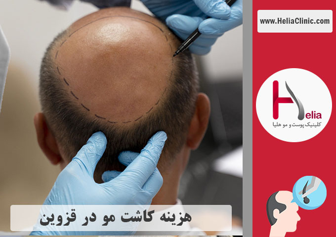 قیمت کاشت موی طبیعی در قزوین