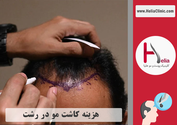 هزینه و تعرفه کاشت مو در شهر رشت
