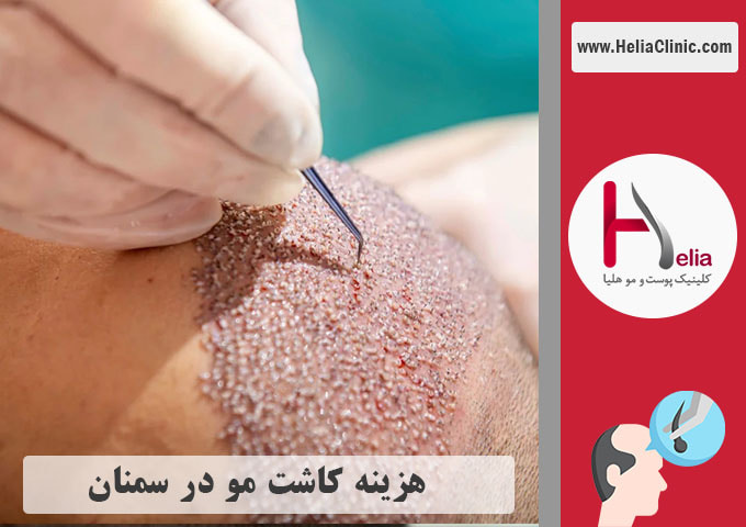 قیمت کاشت مو در سمنان