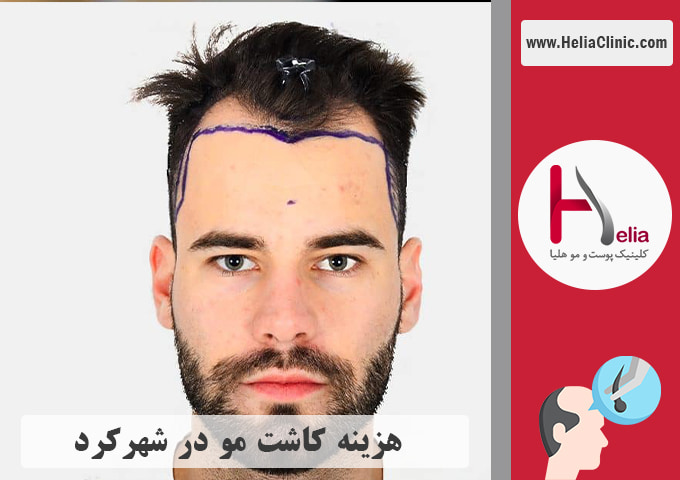 قیمت کاشت موی طبیعی در شهرکرد