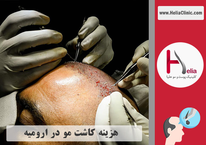 قیمت کاشت مو طبیعی در ارومیه