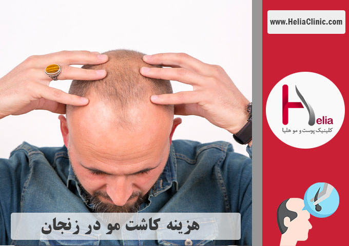 میانگین قیمت کاشت مو در زنجان