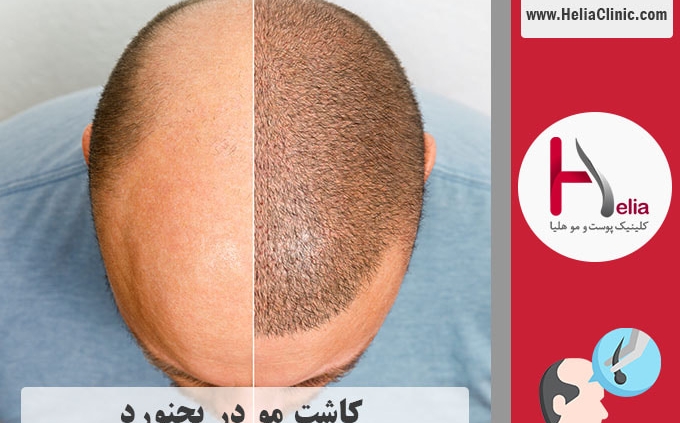 کاشت موی طبیعی در بجنورد