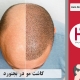 کاشت موی طبیعی در بجنورد