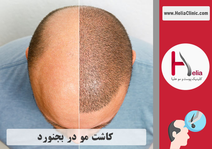 کاشت موی طبیعی در بجنورد