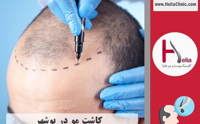 کاشت موی طبیعی در بوشهر