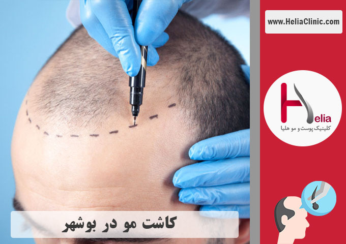 کاشت موی طبیعی در بوشهر