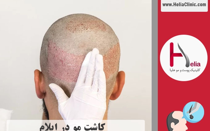 کاشت موی طبیعی در شهر ایلام