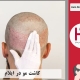 کاشت موی طبیعی در شهر ایلام