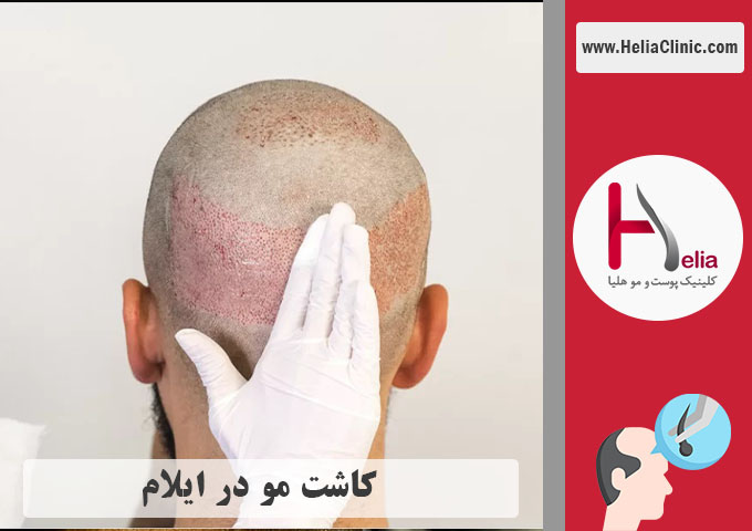 کاشت موی طبیعی در شهر ایلام