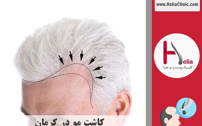 کاشت موی طبیعی در کرمان
