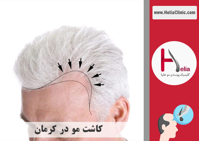 کاشت موی طبیعی در کرمان