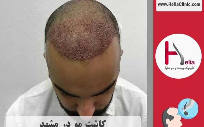 کاشت موی طبیعی در مشهد