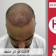 کاشت موی طبیعی در مشهد