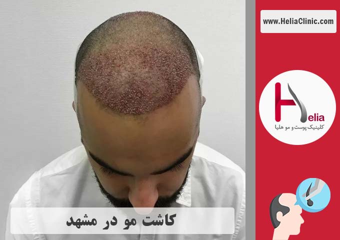 کاشت موی طبیعی در مشهد