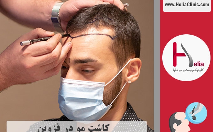کاشت موی طبیعی در قزوین