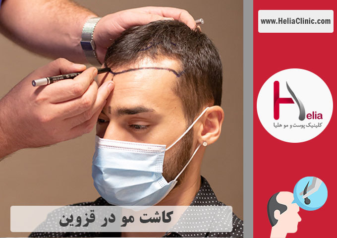 کاشت موی طبیعی در قزوین