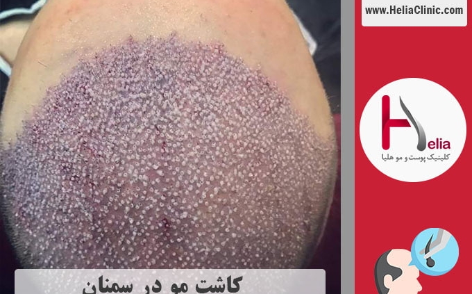 کاشت موی طبیعی در سمنان
