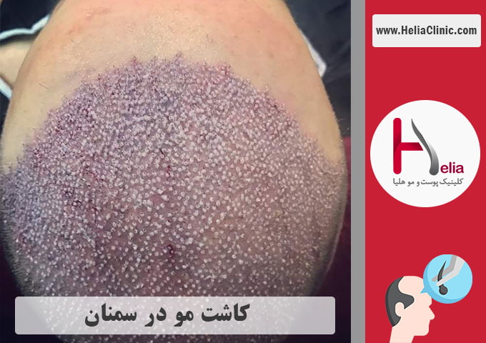 کاشت موی طبیعی در سمنان